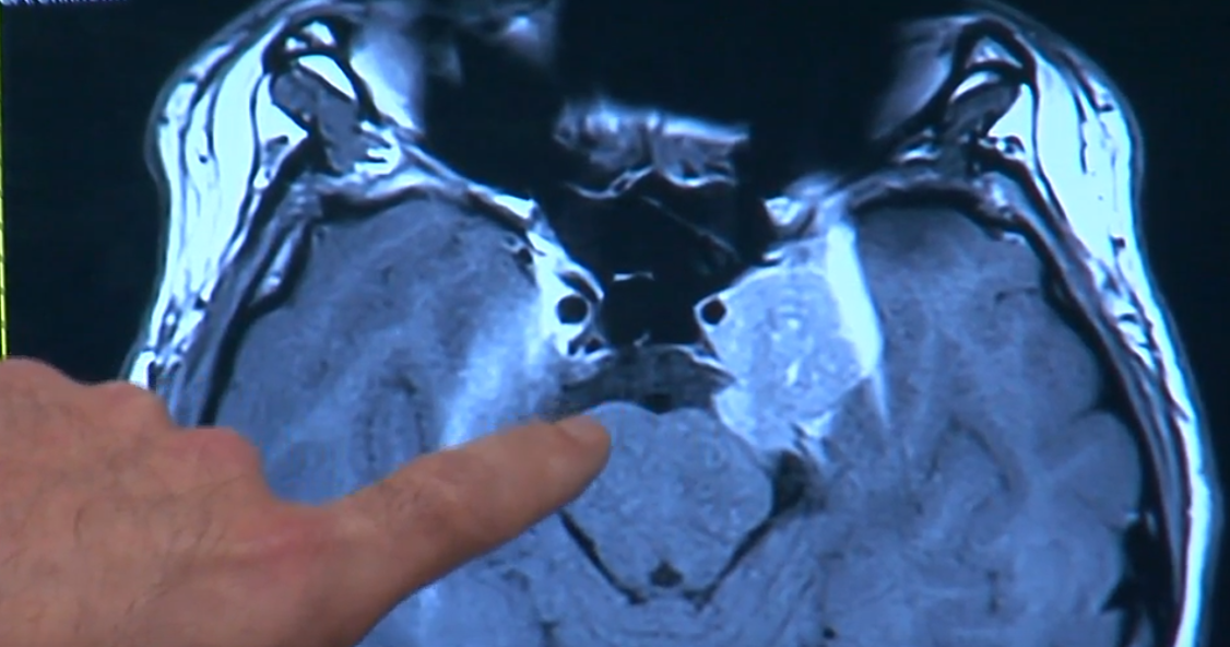 Mayfield Brain and Spine Neurosurgeon Using New Radiation Therapy in Ohio