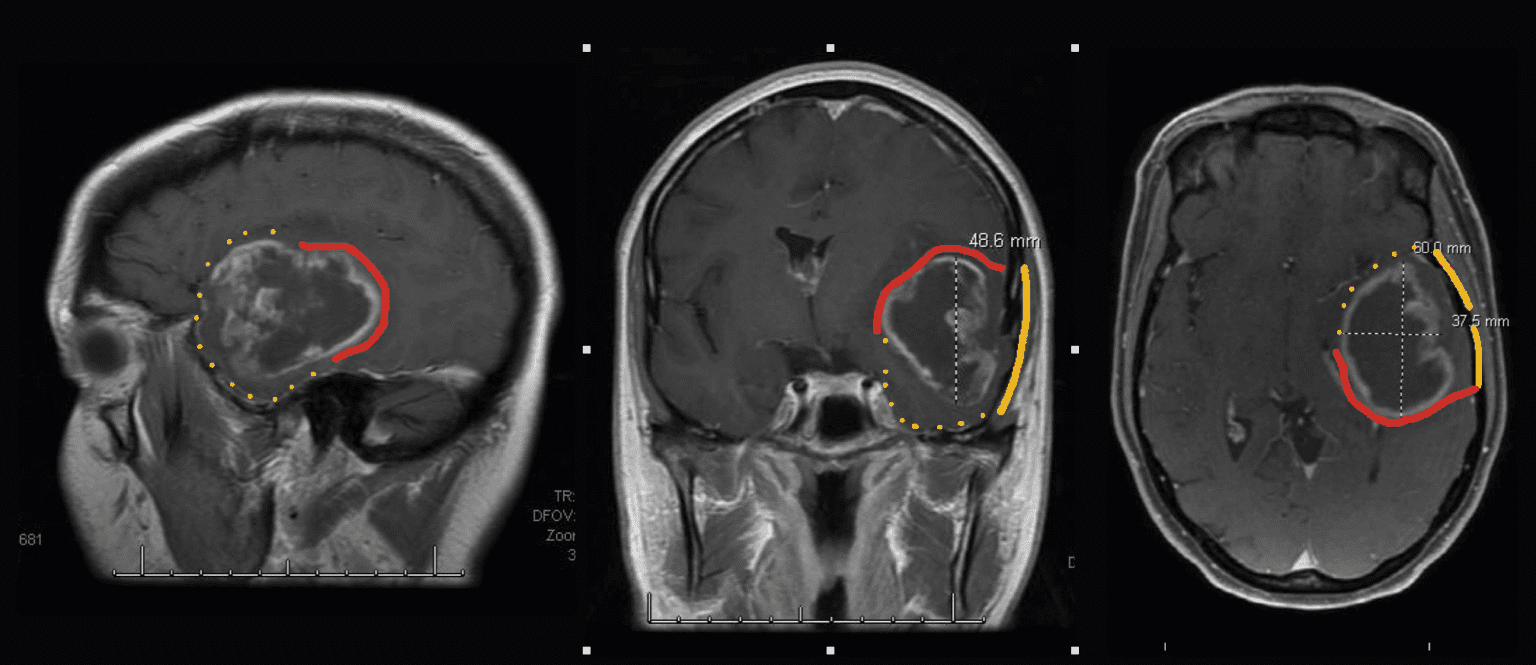 GammaTile Therapy Calculator GT Medical Technologies